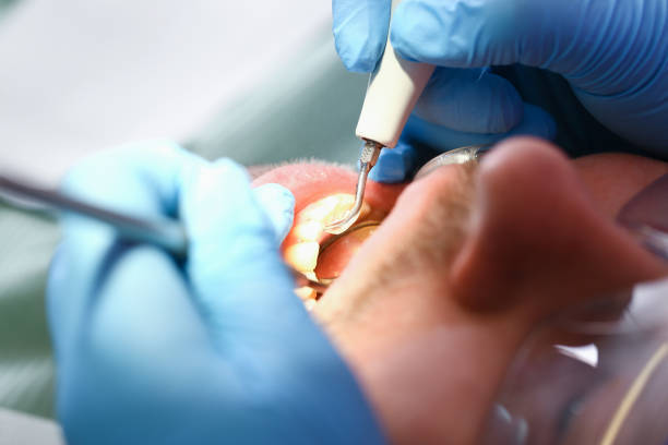 Best Knocked-Out Tooth (Avulsed Tooth) Treatment in Meridian, CO